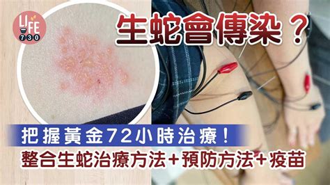 生蛇位置圖|【生蛇】痛楚如火燒？生蛇會傳染嗎？了解生蛇階段、原因及症狀